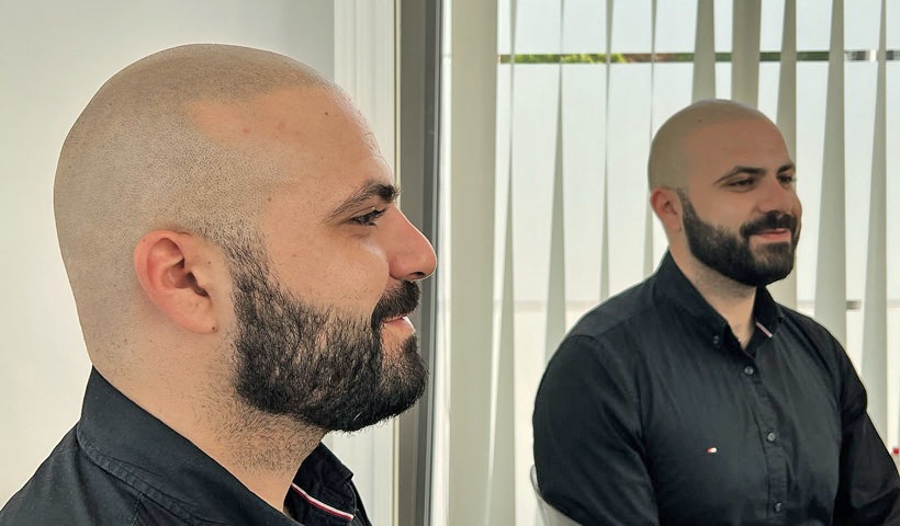 Haarpigmentierung Patient zufrieden nach seiner Behandlung schaut in den Spiegel
