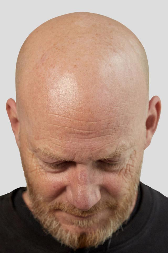 Haarpigmentierung bei einem männlichen Patienten vor der Behandlung