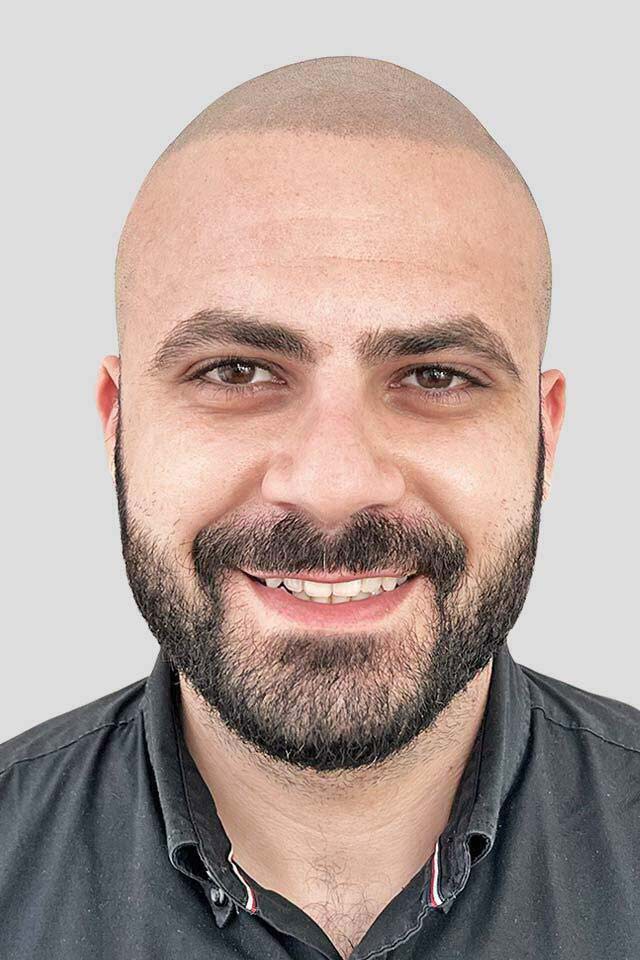 Männlicher Haarpigmentierung Patient lächelt nach seiner Behandlung