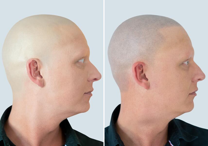 Haarpigmentierung vorher nachher patient München