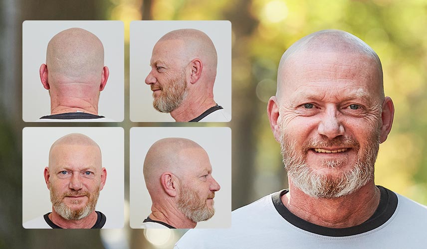 Haarpigmentierung Vorher-Nachher Vergleich bei einem zufriedenen Patienten