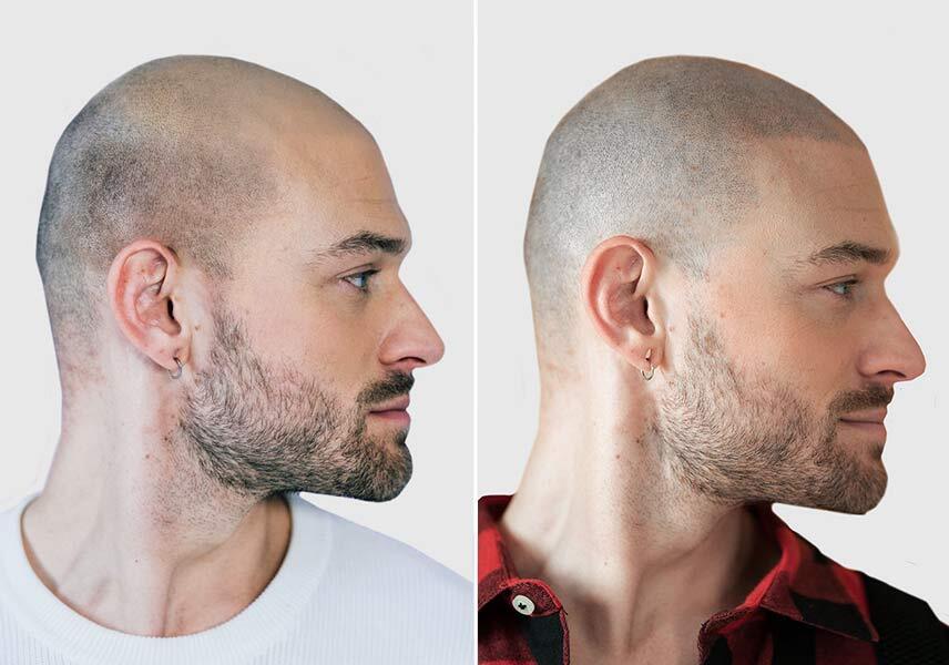 Haarpigmentierung Vorher-Nachher Vergleich bei einem Patienten von der Seite